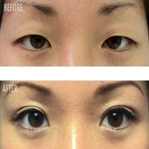 Solution for Hooded, Droopy, Uneven, or Mono Eyelids! from $2.99! Invisible, Transparent Surgical Grade Eyelid Tape Strips.