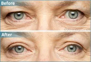 Solution for Hooded, Droopy, Uneven, or Mono Eyelids! from $2.99! Invisible, Transparent Surgical Grade Eyelid Tape Strips.